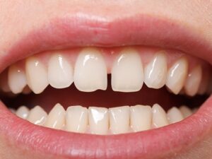 diastema